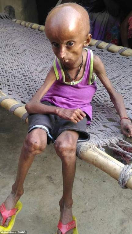 Один на восемь миллионов: парень из Индии стал дряхлым стариком (фото)