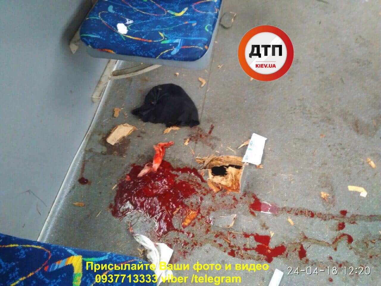 «Трамваи-убийцы»: В столице фрагмент тормозного диска трамвая оторвал пассажирке часть ноги (фото)