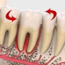 Что такое подвижность зубного ряда и как лечить
