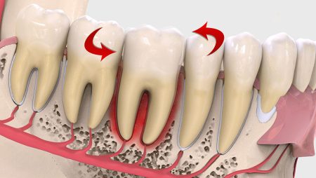 Что такое подвижность зубного ряда и как лечить