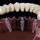 Восстановление зубного ряда при полной потере зубов в «Авроре»